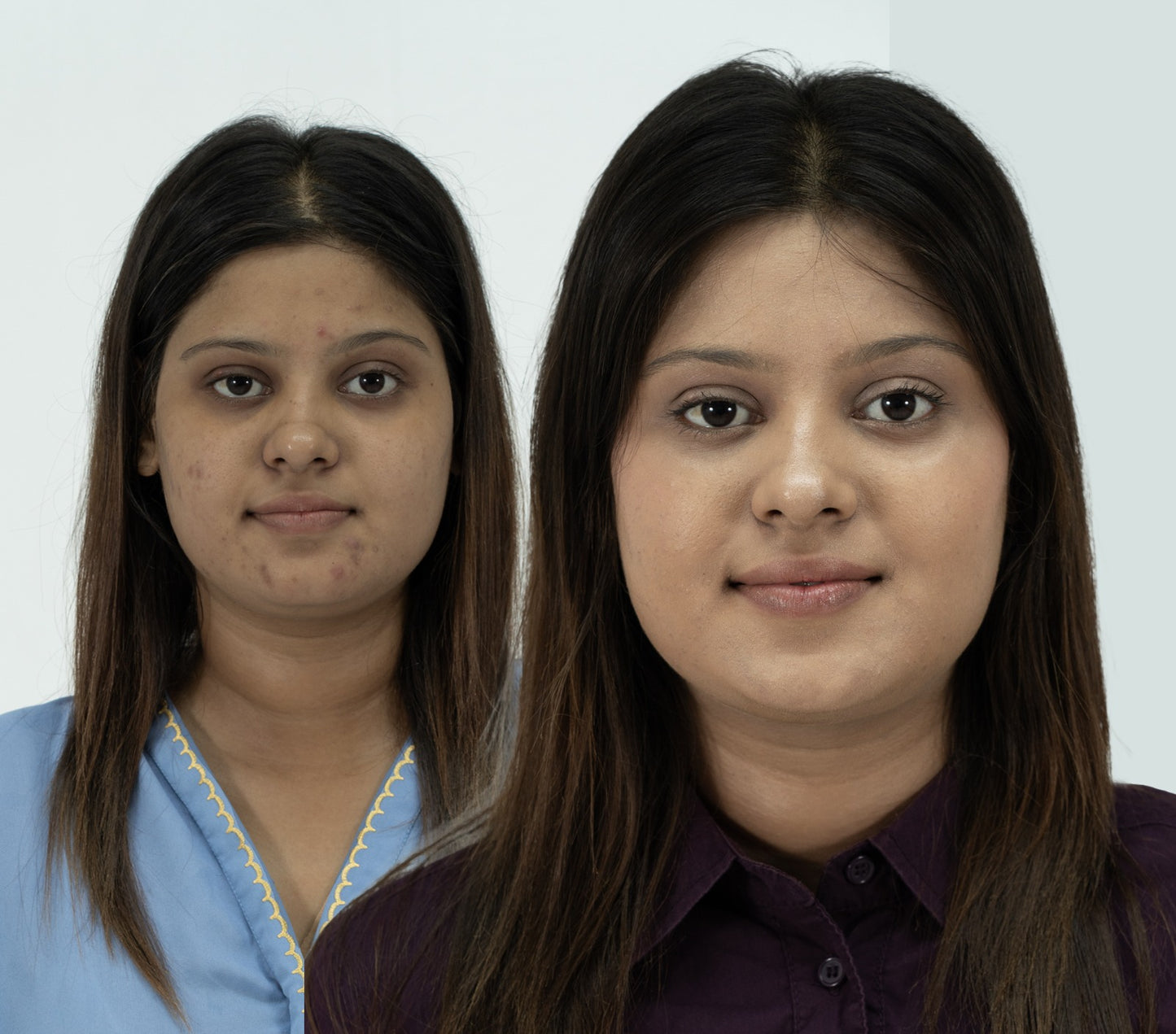 Anti Acne Shoot