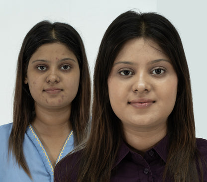 Anti Acne Shoot